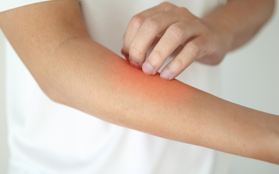 Outdoor Skin Problems in Oregon City: When to Visit Urgent Care for Bug Bites and Summer Infections