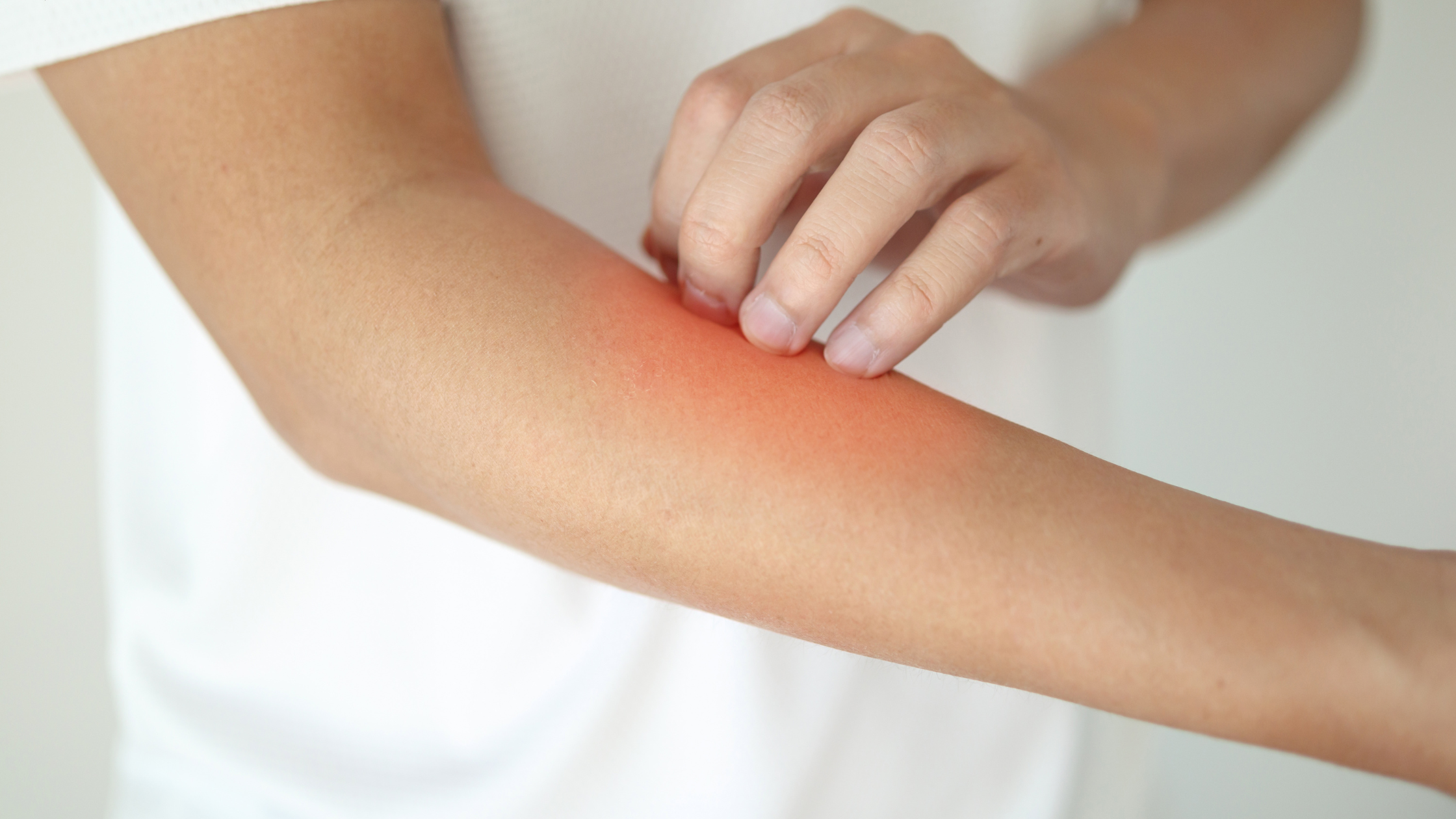 Man scratching inflamed skin.
